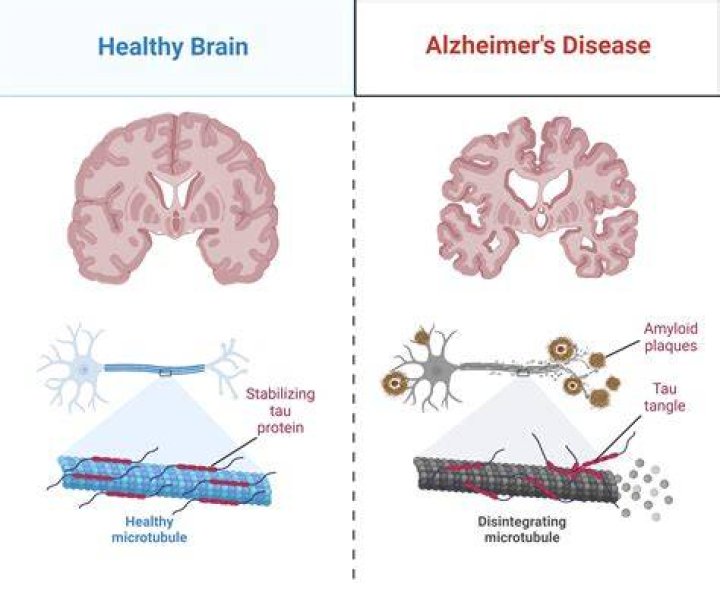 Does Alzheimer's affect your legs?