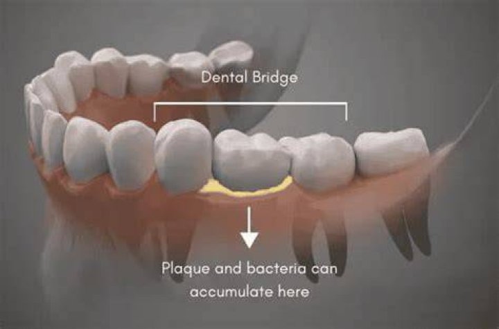 Does food get under a dental bridge?
