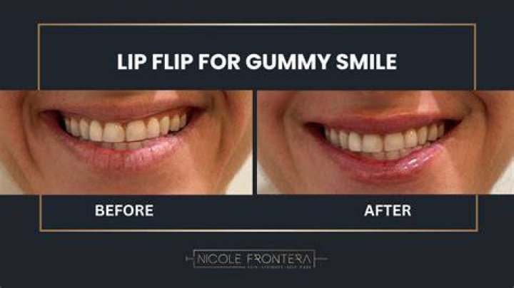 Is gummy smile the same as lip flip?