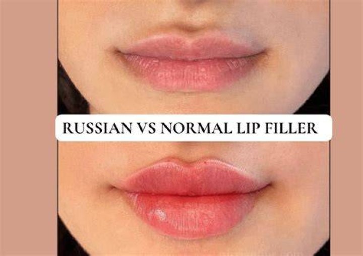 What's the difference between lip filler and Russian lips?