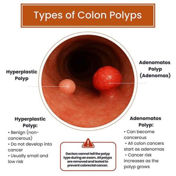 What happens if a removed polyp is cancerous?