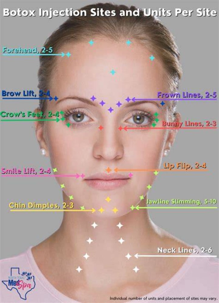 Where is Botox injected for smile lift?